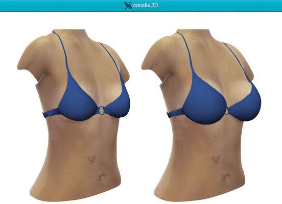 Breast Augmentation 2