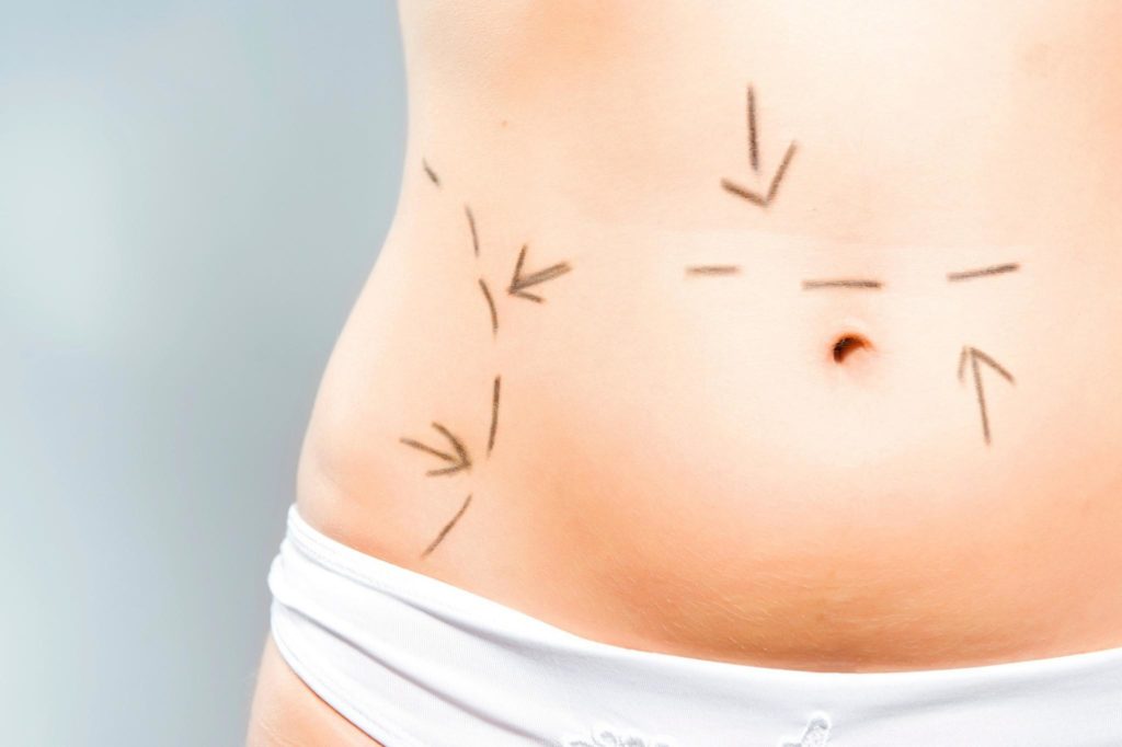 Tummy Tuck